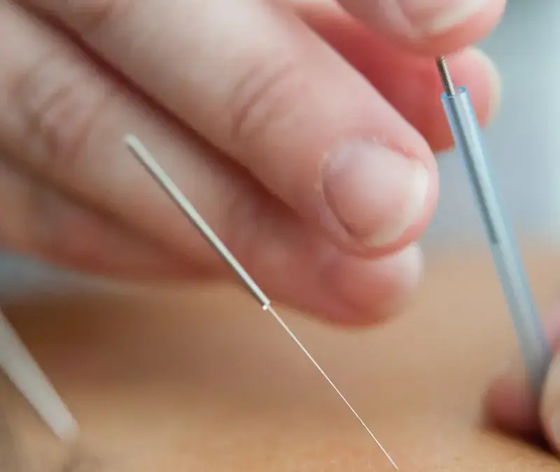 Pain relief without pills: why acupuncture is the natural solution